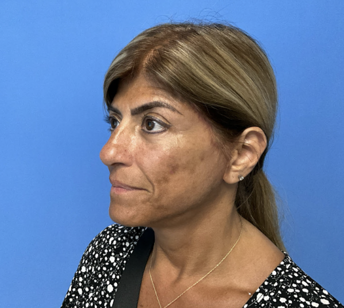 Facelift--Case-Study-2470 | After Face